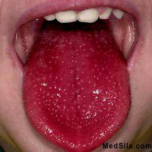 малиновый язык